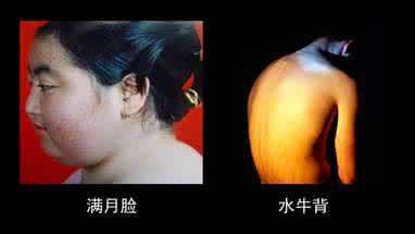 激素在风湿病中的应用