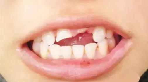 牙齿摔坏了可不是小事！处理不及时酿成苦果，国际牙外伤组织专家：这些错误一定要规避