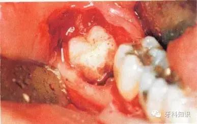 口腔拔牙图片,口腔拔牙麻醉多久消退