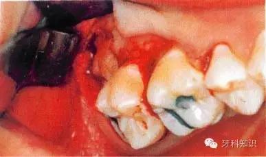 口腔拔牙图片,口腔拔牙麻醉多久消退