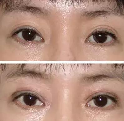 拿什么拯救术后三眼皮