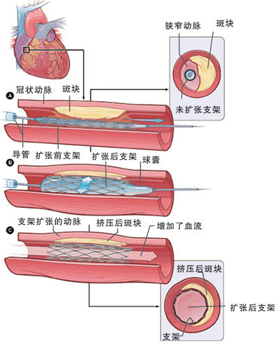 血管淤堵吃红豆能疏通血管吗,血管最怕堵一碗汤让血管干净如新