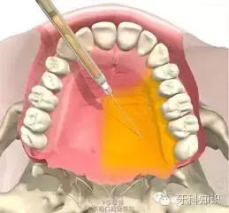 口腔拔牙图片,口腔拔牙麻醉多久消退