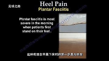 足跟痛的症状及表现,足跟痛最常见病因