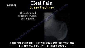 足跟痛的症状及表现,足跟痛最常见病因