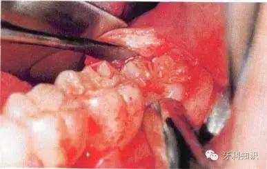 口腔拔牙图片,口腔拔牙麻醉多久消退