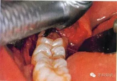 口腔拔牙图片,口腔拔牙麻醉多久消退