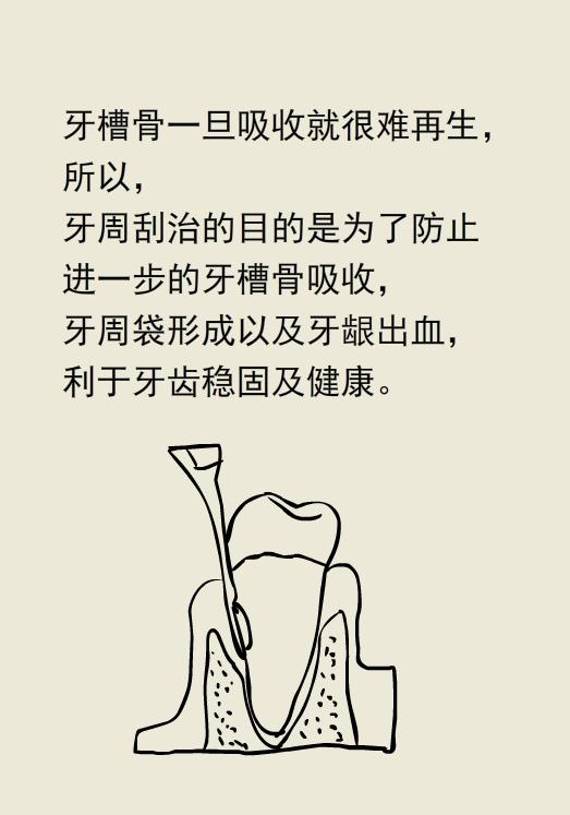 为什么洗牙以后还要做牙周刮治,为什么洗牙后还要刮治