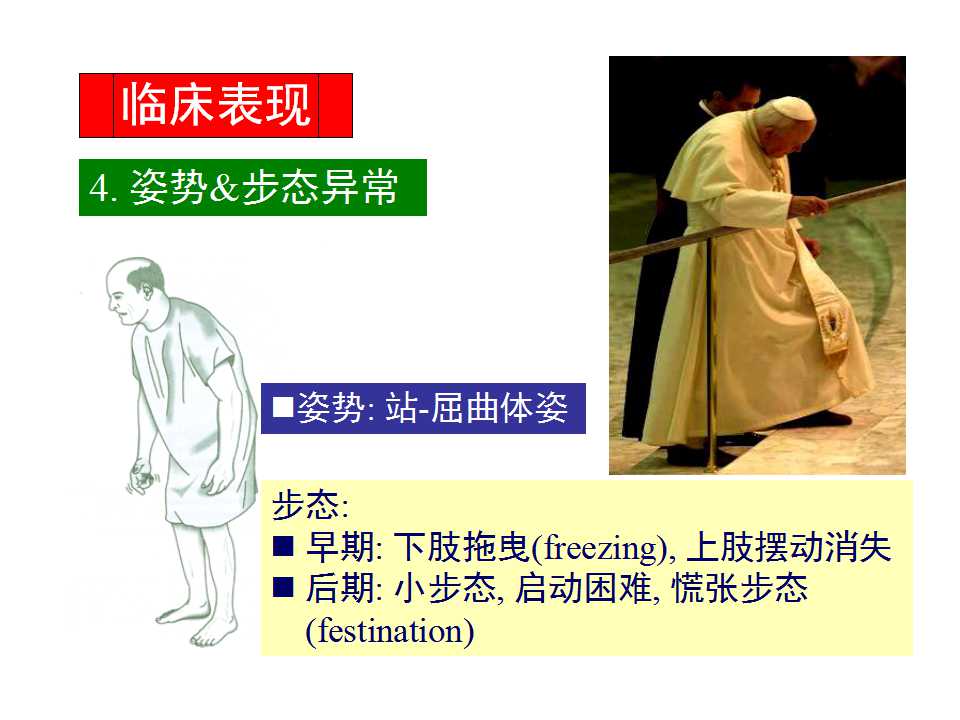 多图详解帕金森及运动障碍性疾病|关于帕金森最全的一个课件