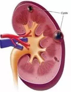 肾脏长了个囊肿怎么办,肾脏长了个囊肿应注意什么