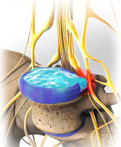 腰椎间盘突出能够完全治好吗,腰椎间盘突出能够手术吗