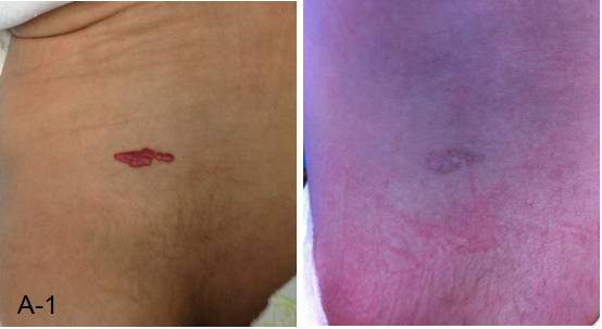 婴幼儿脸上有胎记怎么办,治疗婴幼儿红胎记哪里好