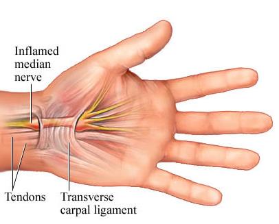 就医搜｜腕管综合征：容易在键盘上“敲”出的疾病！