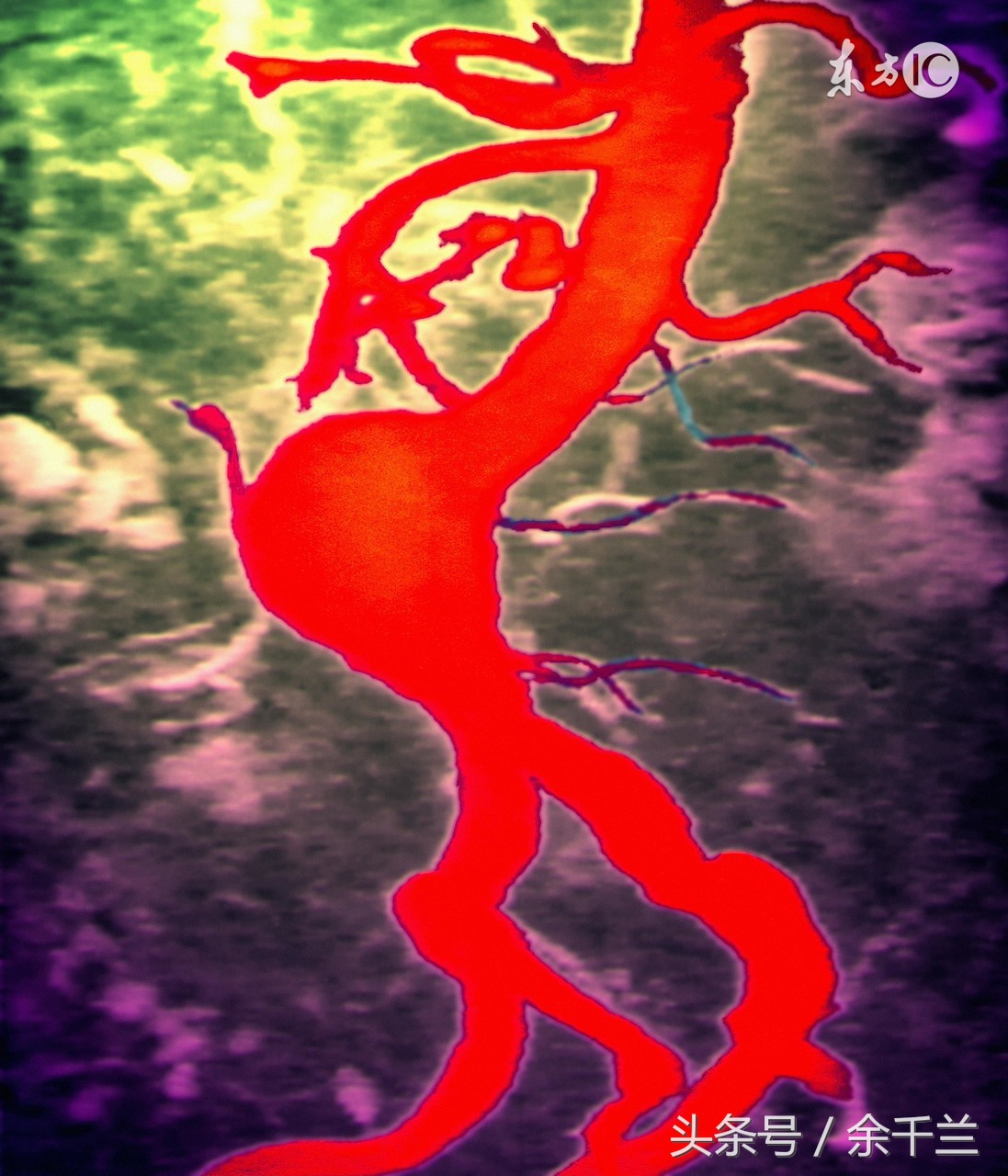 患高血压几十年他们是怎样控制的,得了高血压每天吃几片药