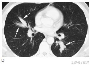 肺里长出小球球,不是吞进去的,而是真菌寄生在里面形成的,严重时可导致大出血