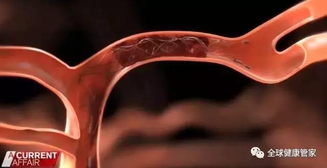 澳洲治疗中风可怕副作用,澳洲十大黑科技药