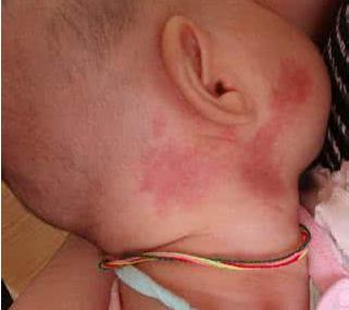 胎记表面粗糙像结痂,胎记表面有小疙瘩