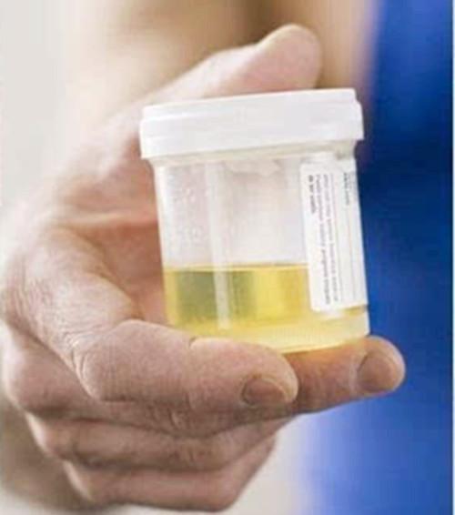 怀孕尿检什么指标,尿检指标科学解读