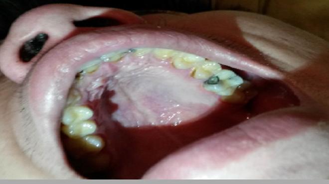 牙齿有黑洞怎么办?医生说这样做可缓解疼痛