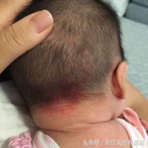 宝宝胎记为何“同记不同命”是因为你陷入了这几个误区