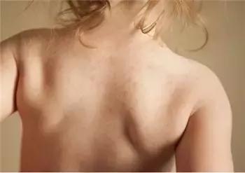 宝宝长痱子用什么方法最好,宝宝长痱子最好的解决办法是什么