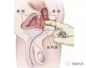 直肠前突是怎么回事,得了直肠前突会死吗