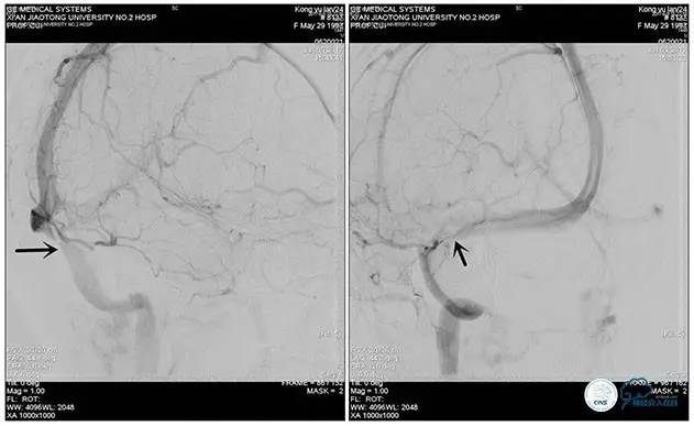脑静脉窦狭窄做支架危险吗,静脉窦狭窄做支架后多久恢复