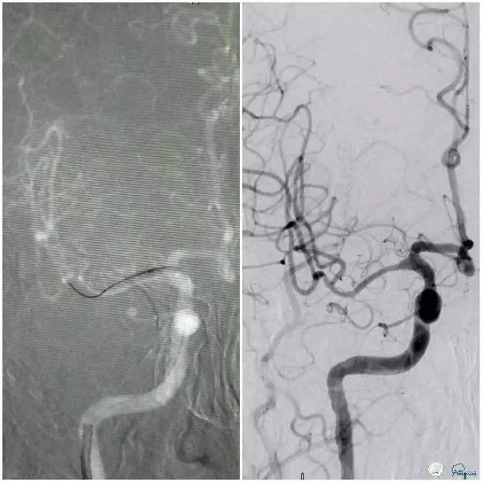 右侧大脑后动脉p1段狭窄支架手术,天坛周记
