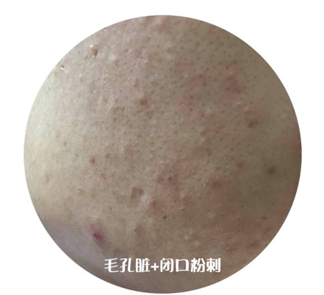 十年战痘血泪史详解,战痘知识分享