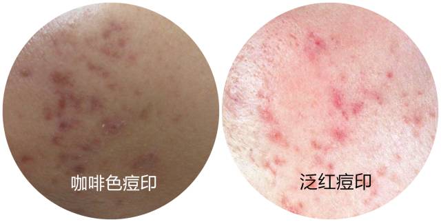 战痘大结局完整版,战痘合集完整版