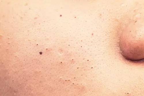 战痘大结局完整版,战痘合集完整版