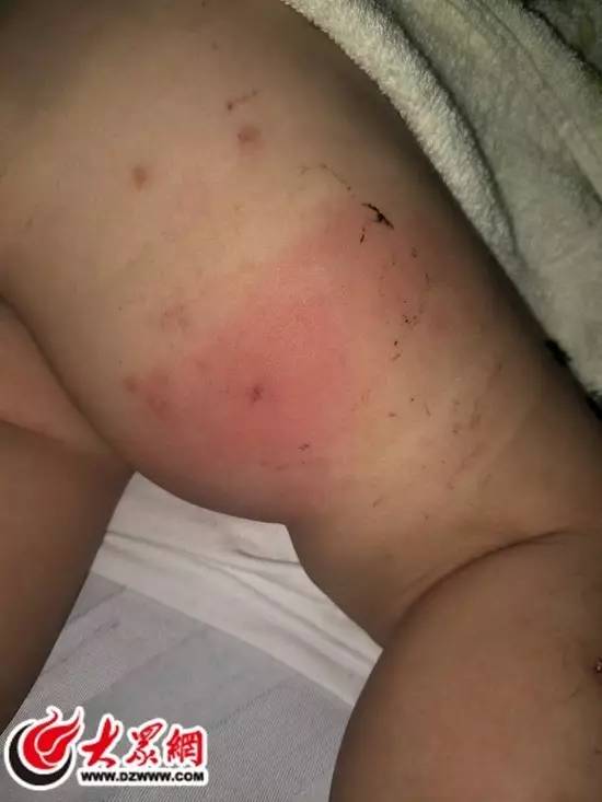 儿童被什么虫咬到可能丧命,孩子被蜱虫咬了三天低烧
