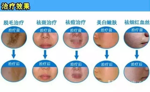 再也不担心脸上长痘痘,再也不用因为痘痘而烦恼