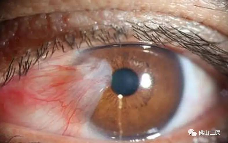 眼皮表面上长的赘生物,眼上的赘生物是什么