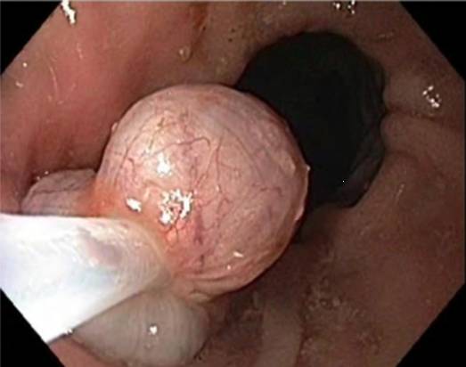 内镜下肌切开术手术步骤,肌肉活检最新技术