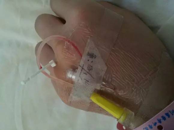 留置针封闭好后回血正常吗,宝宝留置针回血了要不要紧