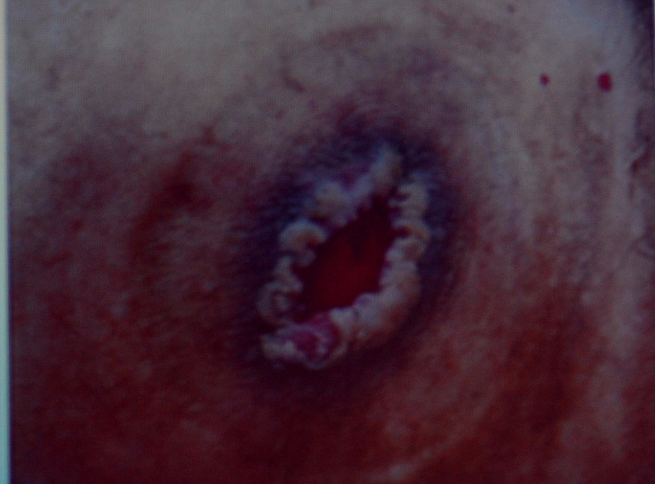 肠造口常见周围皮肤并发症,肠造口护理操作并发症