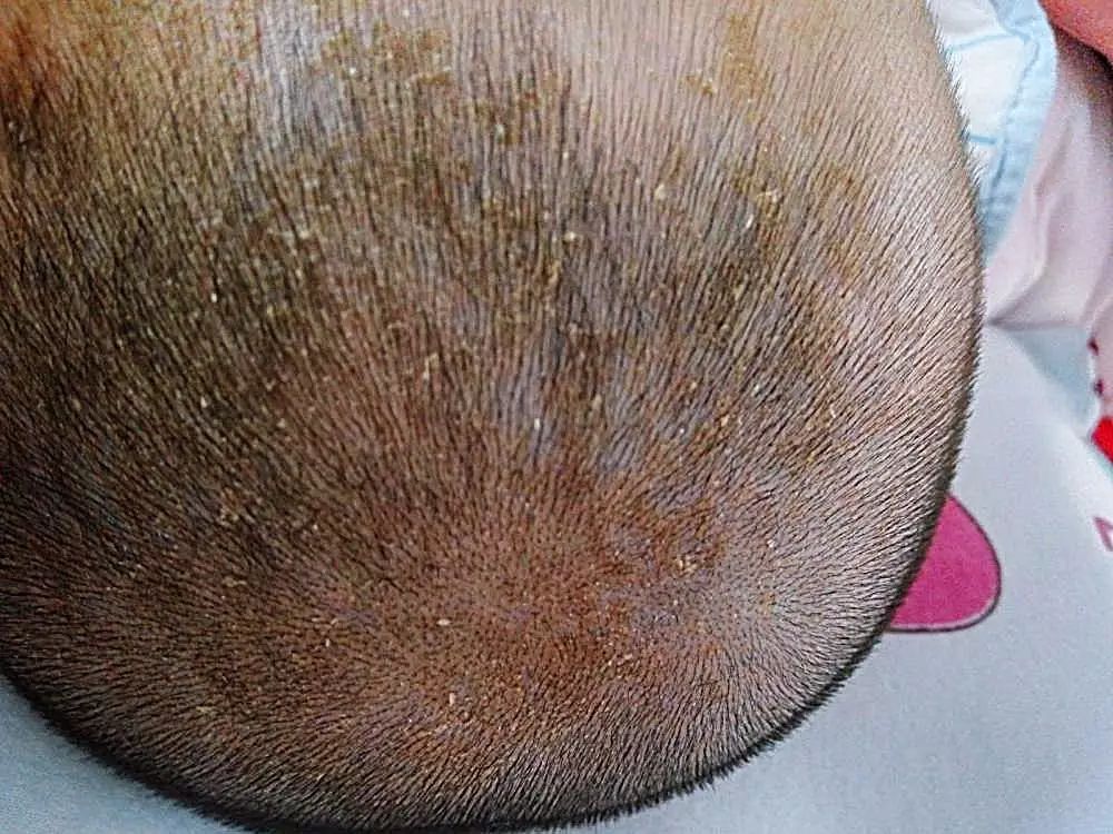 宝宝头上的乳痂用手直接抠下来,宝宝头上有凸起抠下来硬硬的结痂