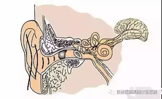 面瘫不恢复是因为风没出来吗,面瘫都是风的原因吗
