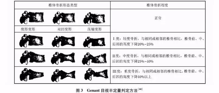 2017原发性骨质疏松诊疗指南,原发性骨质疏松症诊疗指南