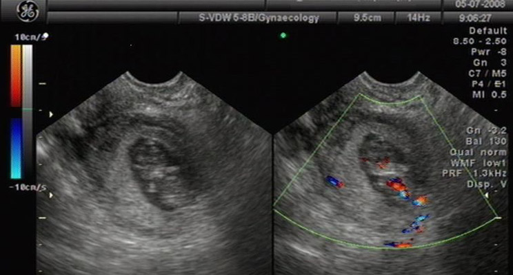 宫外孕相关知识讲解,一分钟看懂宫外孕知识