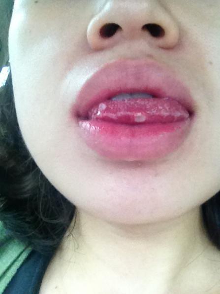 治疗口腔溃疡的2个方法简单易懂,治疗口腔溃疡最快速有效的方法