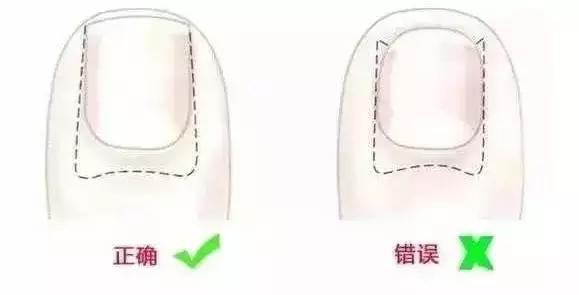 给婴儿剪脚指甲怎么预防甲沟炎,宝宝甲沟炎如何剪脚趾甲