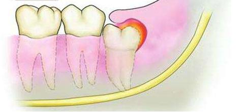 牙龈肿痛怎么治疗最好,治疗牙龈肿痛的中药方