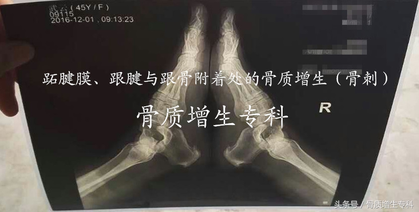 腰椎曲度变直并骨质增生怎么锻炼,颈椎间盘突出加骨质增生锻炼方法