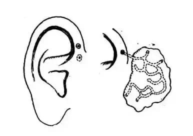 耳朵上有小洞到底有多可怕,耳朵上有个小孔后天形成