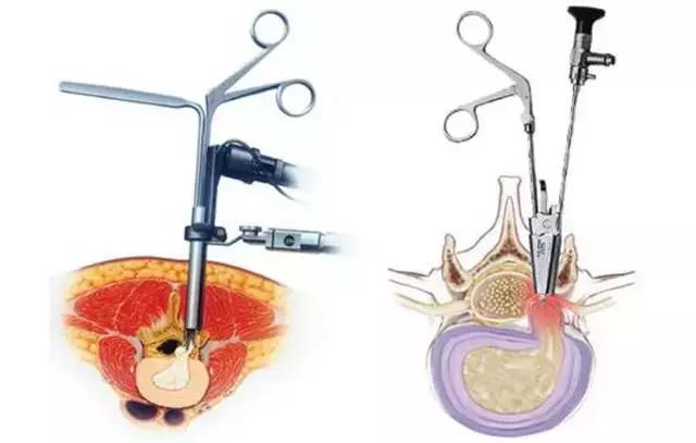 腰椎间盘突出有什么好的治疗方法,70岁老人腰椎间盘突出适合手术吗