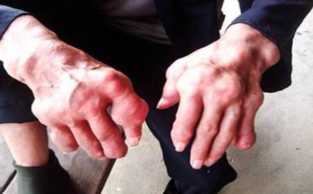 痛风还得是刚做完手术的飞哥跟你聊