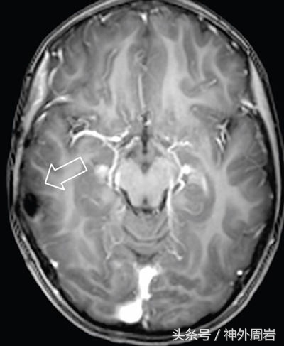 痴笑癫痫发作时会怎样,痴笑性型癫痫病发作是什么感觉