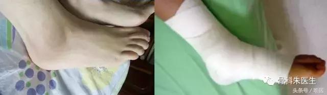 踝关节骨折没有手术怎么办,骨折保守治疗可以活动踝关节吗